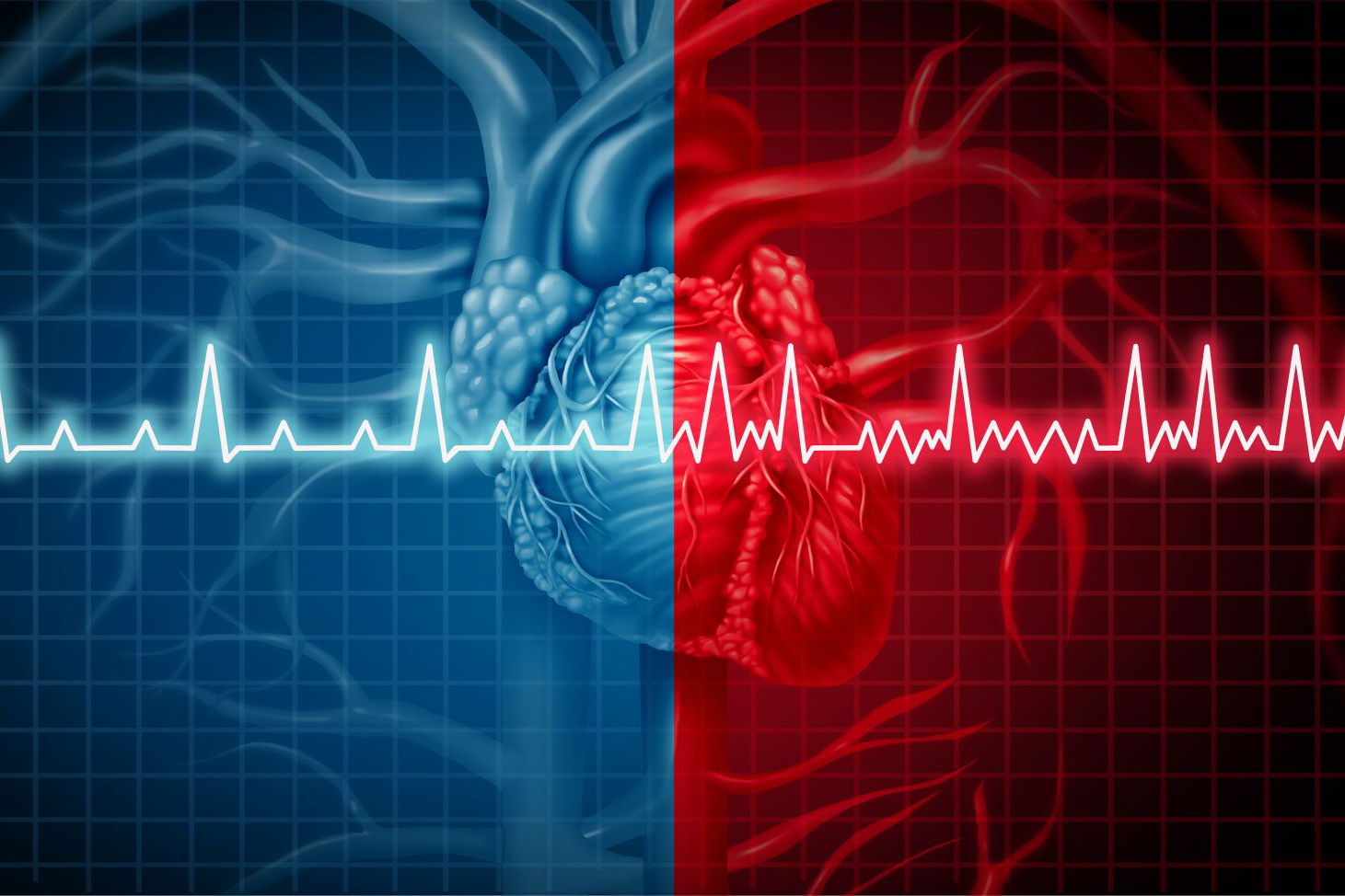 fibrillazione atriale - cardiologia - poliambulatorio finazzo