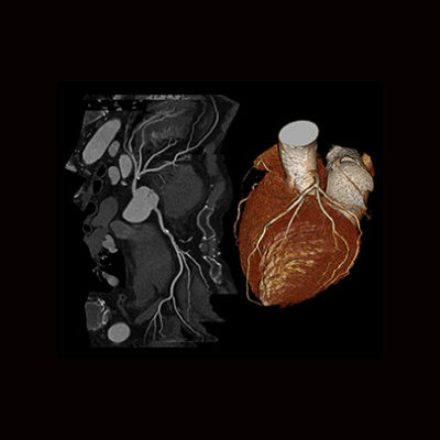cardiotac